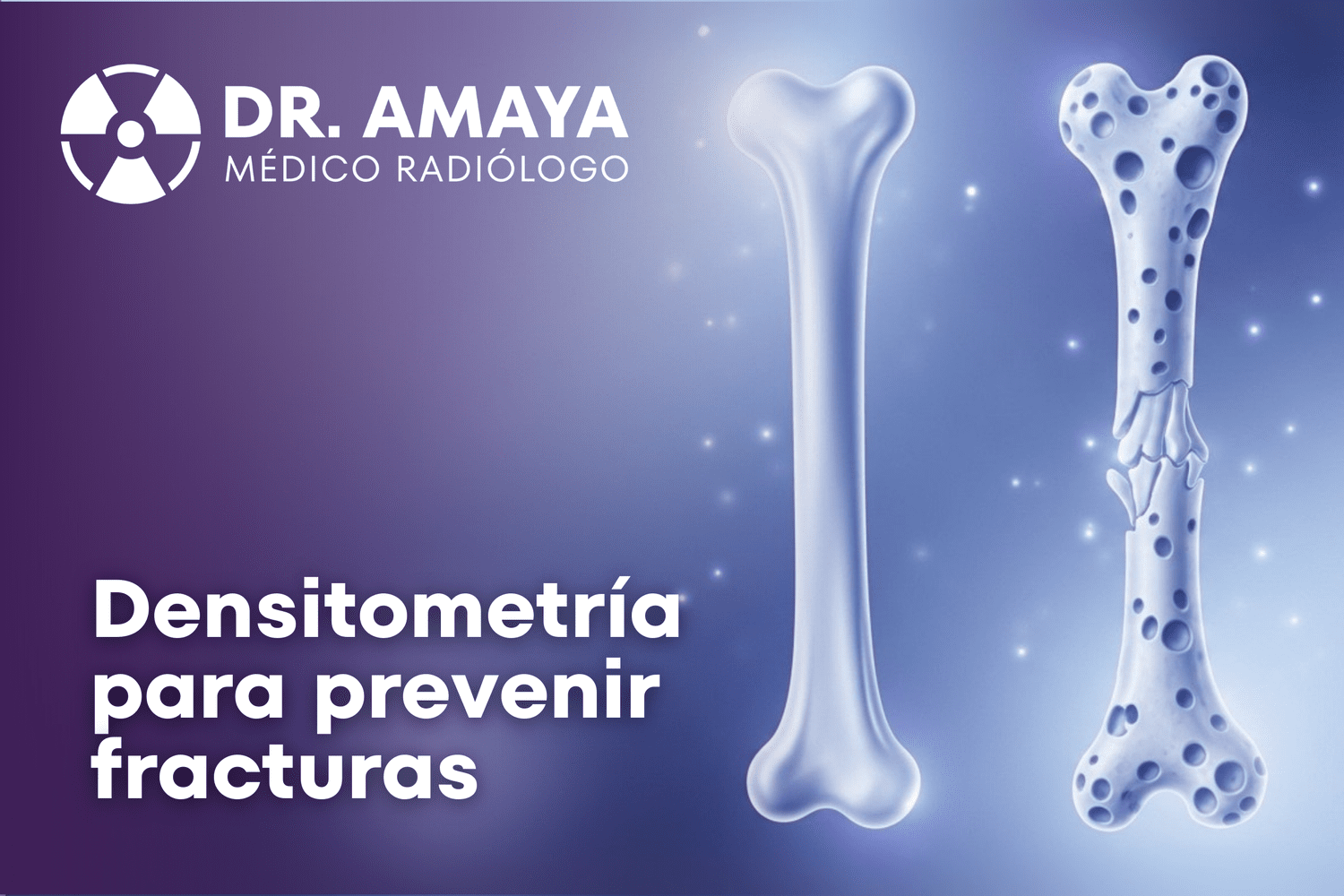 ¿Sabías que un estudio puede predecir fracturas?