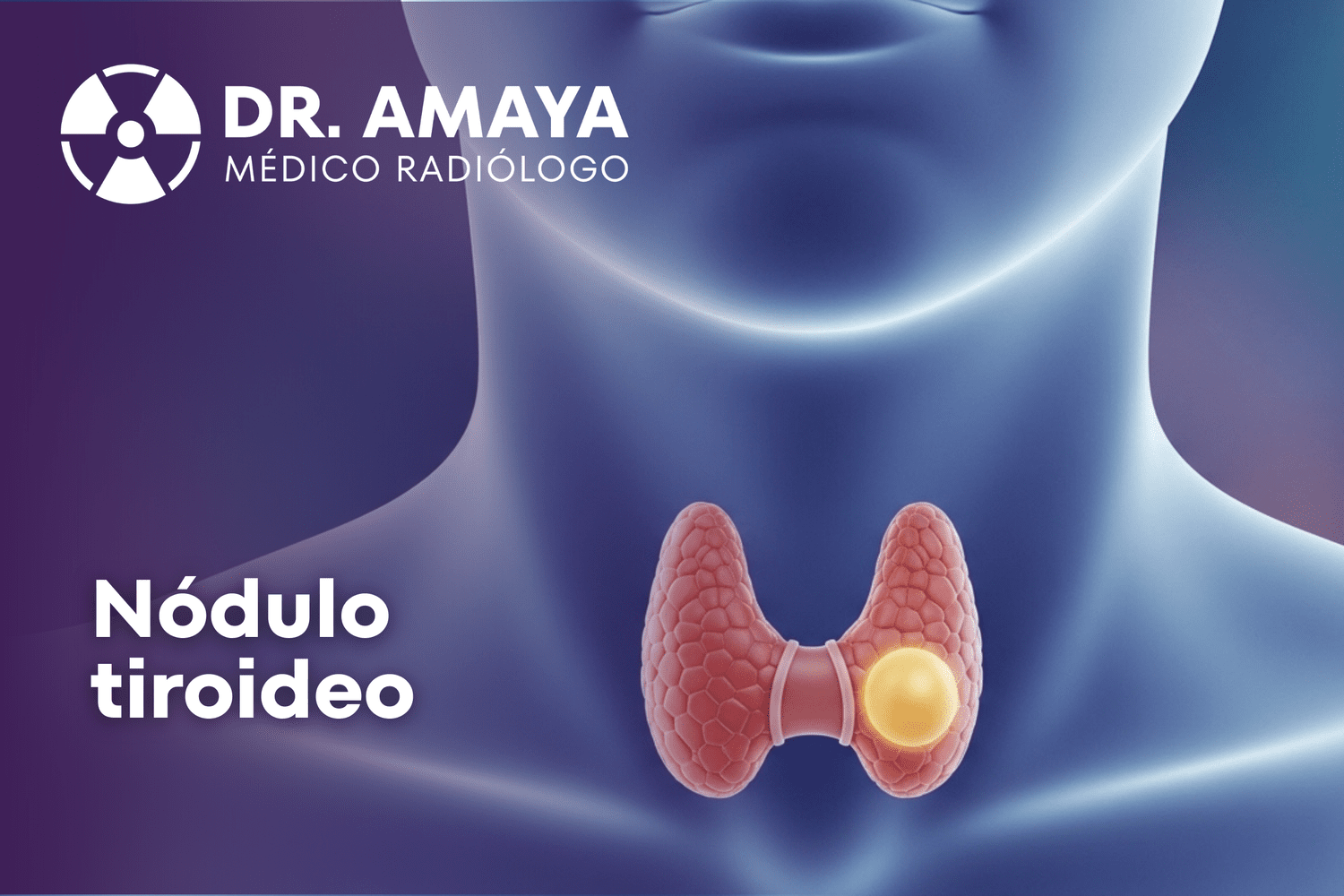 ¿Qué es un nódulo tiroideo?
