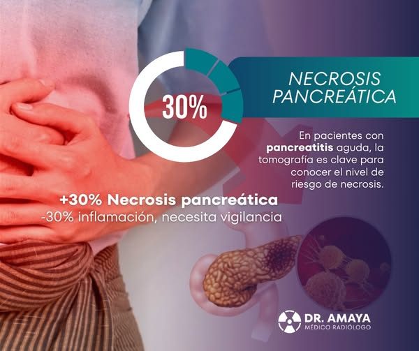 𝙉𝙚𝙘𝙧𝙤𝙨𝙞𝙨 𝙥𝙖𝙣𝙘𝙧𝙚𝙖́𝙩𝙞𝙘𝙖 𝙮 𝙡𝙖 𝙧𝙚𝙜𝙡𝙖 𝙙𝙚𝙡 𝟯𝟬 %