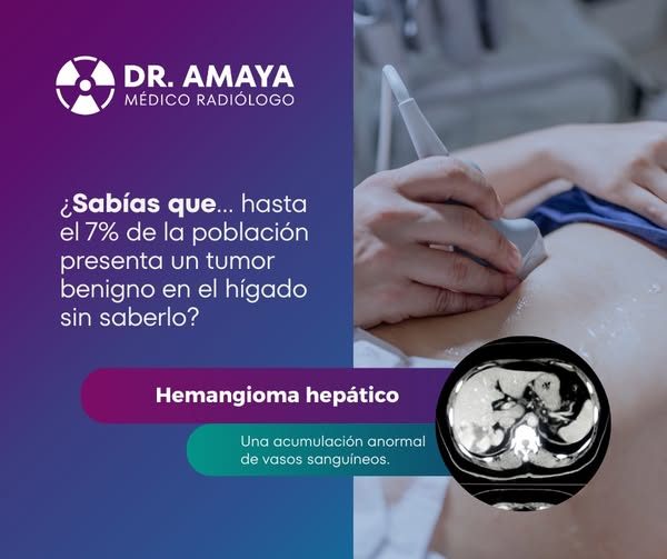 Se trata del 𝙝𝙚𝙢𝙖𝙣𝙜𝙞𝙤𝙢𝙖 𝙝𝙚𝙥𝙖́𝙩𝙞𝙘𝙤, una acumulación anormal…