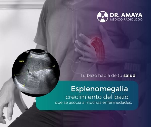 𝙏𝙪 𝙗𝙖𝙯𝙤 𝙝𝙖𝙗𝙡𝙖 𝙙𝙚 𝙩𝙪 𝙨𝙖𝙡𝙪𝙙: conoce la ESPLENOMEGALIA