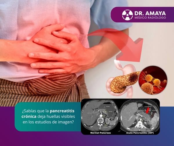 𝙋𝙖𝙣𝙘𝙧𝙚𝙖𝙩𝙞𝙩𝙞𝙨 𝙘𝙧𝙤́𝙣𝙞𝙘𝙖: ¿𝙘𝙤́𝙢𝙤 𝙡𝙖 𝙫𝙚𝙢𝙤𝙨 𝙚𝙣 𝙞�…